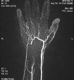 d Scleroderma Occluded Superficial Palmar Arch